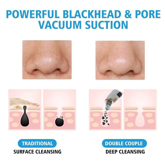 Blackhead Remover Tool